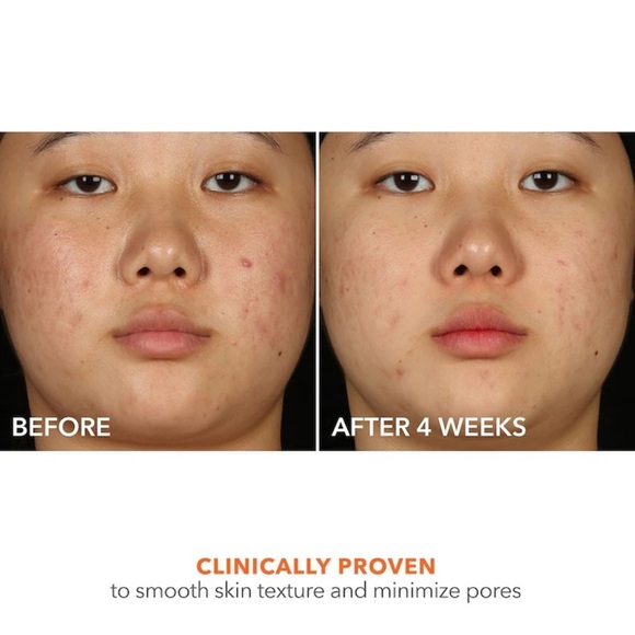 🆕 DR DENNIS GROSS Skincare Alpha Beta® 2% BHA + Breakout Solution 150 mL NWOB - Picture 12 of 13